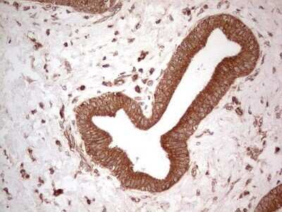 Immunohistochemistry: UbcH5b/UBE2D2 Antibody (OTI2C2) - Azide and BSA Free [NBP2-74732] - Analysis of Carcinoma of Human pancreas tissue. (Heat-induced epitope retrieval by 1 mM EDTA in 10mM Tris, pH8.5, 120C for 3min)