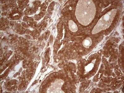 Immunohistochemistry: UbcH5b/UBE2D2 Antibody (OTI2C2) - Azide and BSA Free [NBP2-74732] - Analysis of Carcinoma of Human thyroid tissue. (Heat-induced epitope retrieval by 1 mM EDTA in 10mM Tris, pH8.5, 120C for 3min)