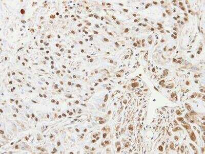 Immunohistochemistry-Paraffin: UbcH7/UBE2L3 Antibody [NBP1-30995] - A549 xenograft, using UBE2L3 antibody at 1:100 dilution. Antigen Retrieval: Trilogy™ (EDTA based, pH 8.0) buffer, 15min.