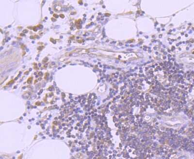 Immunohistochemistry-Paraffin: Ubiquitin B Antibody (JM09-67) [NBP2-66759] - Analysis of paraffin-embedded human colon cancer tissue using anti-K63-linkage Specific Ubiquitin antibody. Counter stained with hematoxylin.