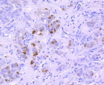 Immunohistochemistry-Paraffin: Ubiquitin B Antibody (JM09-67) [NBP2-66759] - Analysis of paraffin-embedded human liver cancer tissue using anti-K63-linkage Specific Ubiquitin antibody. Counter stained with hematoxylin.