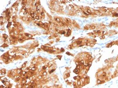 Immunohistochemistry-Paraffin: Uroplakin Ia Antibody (UPK1A/2922) - Azide and BSA Free [NBP2-79869] - Formalin-fixed, paraffin-embedded human Urothelial Carcinoma stained with Uroplakin 1A Mouse Monoclonal Antibody (UPK1A/2922).