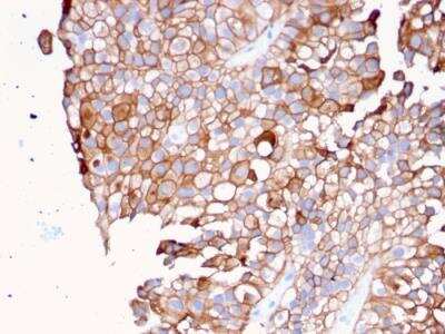 Immunohistochemistry-Paraffin: Uroplakin Ib Antibody (UPK1B/3081) - Azide and BSA Free [NBP2-79933] - Formalin-fixed, paraffin-embedded human Urothelial Carcinoma stained with Uroplakin 1B Mouse Monoclonal Antibody (UPK1B/3081).