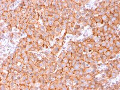 Immunohistochemistry-Paraffin: Uroplakin Ib Antibody (UPK1B/3081) - Azide and BSA Free [NBP2-79933] - Formalin-fixed, paraffin-embedded human Urothelial Carcinoma stained with Uroplakin 1B Mouse Monoclonal Antibody (UPK1B/3081).