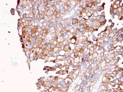 Immunohistochemistry-Paraffin: Uroplakin Ib Antibody (UPK1B/3081) [NBP2-79799] - Formalin-fixed, paraffin-embedded human Urothelial Carcinoma stained with Uroplakin Ib Antibody (UPK1B/3081).