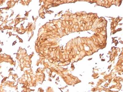 Immunohistochemistry-Paraffin: Uroplakin Ib Antibody (UPK1B/3081) [NBP2-79799] - Formalin-fixed, paraffin-embedded human Urothelial Carcinoma stained with Uroplakin Ib Antibody (UPK1B/3081).