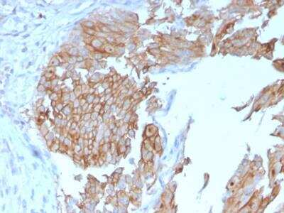 Immunohistochemistry-Paraffin: Uroplakin Ib Antibody (UPK1B/3102) - Azide and BSA Free [NBP2-79934] - Formalin-fixed, paraffin-embedded human Urothelial Carcinoma stained with Uroplakin 1B Mouse Monoclonal Antibody (UPK1B/3102).