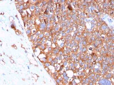 Immunohistochemistry-Paraffin: Uroplakin Ib Antibody (UPK1B/3102) - Azide and BSA Free [NBP2-79934] - Formalin-fixed, paraffin-embedded human Urothelial Carcinoma stained with Uroplakin 1B Mouse Monoclonal Antibody (UPK1B/3102).