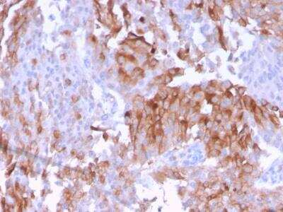 Immunohistochemistry-Paraffin: Uroplakin Ib Antibody (UPK1B/3102) - Azide and BSA Free [NBP2-79934] - Formalin-fixed, paraffin-embedded human Urothelial Carcinoma stained with Uroplakin 1B Mouse Monoclonal Antibody (UPK1B/3102).