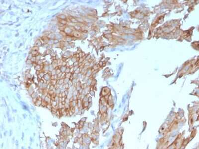 Immunohistochemistry-Paraffin: Uroplakin Ib Antibody (UPK1B/3102) [NBP2-79800] - Formalin-fixed, paraffin-embedded human Urothelial Carcinoma stained with Uroplakin Ib Antibody (UPK1B/3102).