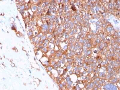 Immunohistochemistry-Paraffin: Uroplakin Ib Antibody (UPK1B/3102) [NBP2-79800] - Formalin-fixed, paraffin-embedded human Urothelial Carcinoma stained with Uroplakin Ib Antibody (UPK1B/3102).