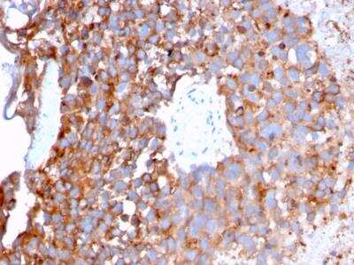 Immunohistochemistry-Paraffin: Uroplakin Ib Antibody (UPK1B/3273) - Azide and BSA Free [NBP2-79935] - Formalin-fixed, paraffin-embedded human Urothelial Carcinoma stained with Monospecific Mouse Monoclonal Antibody to Uroplakin 1B (UPK1B/3273).