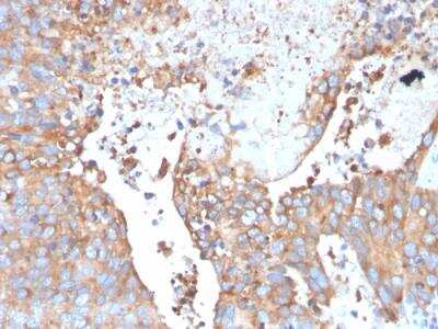 Immunohistochemistry-Paraffin: Uroplakin Ib Antibody (UPK1B/3273) - Azide and BSA Free [NBP2-79935] - Formalin-fixed, paraffin-embedded human Urothelial Carcinoma stained with Monospecific Mouse Monoclonal Antibody to Uroplakin 1B (UPK1B/3273).