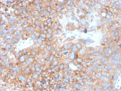 Immunohistochemistry-Paraffin: Uroplakin Ib Antibody (UPK1B/3273) - Azide and BSA Free [NBP2-79935] - Formalin-fixed, paraffin-embedded human Urothelial Carcinoma stained with Monospecific Mouse Monoclonal Antibody to Uroplakin 1B (UPK1B/3273).