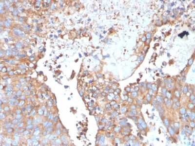 Immunohistochemistry-Paraffin: Uroplakin Ib Antibody (UPK1B/3273) [NBP2-79801] - Formalin-fixed, paraffin-embedded human Urothelial Carcinoma stained with Uroplakin Ib Antibody (UPK1B/3273).