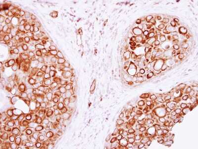 Immunohistochemistry-Paraffin: VAM1 Antibody [NBP2-15158] - Human breast cancer, using VAM1 antibody at 1:250 dilution. Antigen Retrieval: Trilogy™ (EDTA based, pH 8.0) buffer, 15min. 
