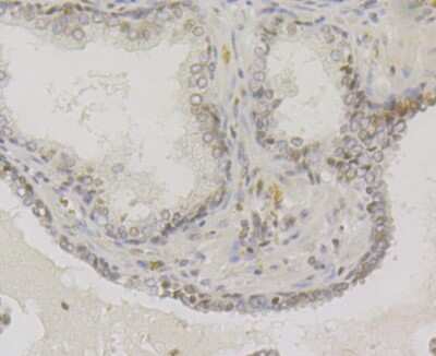 Immunohistochemistry-Paraffin: VAMP-1 Antibody (JG40-19) [NBP2-76877] - Analysis of  human prostate cancer tissue using anti-VAMP1 antibody. Counter stained with hematoxylin.