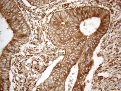 Immunohistochemistry: VAP-A Antibody (10E10) [NBP2-46319] - Analysis of Adenocarcinoma of Human colon tissue. (Heat-induced epitope retrieval by 1mM EDTA in 10mM Tris buffer (pH8.5) at 120C for 3 min)