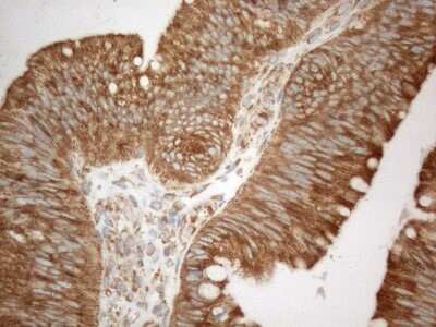 Immunohistochemistry: VAP-A Antibody (10E10) [NBP2-46319] - Analysis of Carcinoma of Human pancreas tissue. (Heat-induced epitope retrieval by 1mM EDTA in 10mM Tris buffer (pH8.5) at 120C for 3 min)