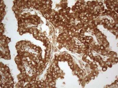 Immunohistochemistry: VAP-A Antibody (10E10) [NBP2-46319] - Analysis of Carcinoma of Human thyroid tissue. (Heat-induced epitope retrieval by 1mM EDTA in 10mM Tris buffer (pH8.5) at 120C for 3 min)