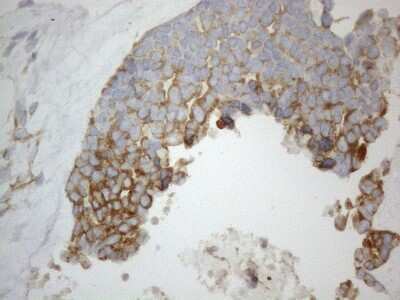 Immunohistochemistry: VAP-A Antibody (10E10) [NBP2-46319] - Analysis of Adenocarcinoma of Human endometrium tissue. (Heat-induced epitope retrieval by 1mM EDTA in 10mM Tris buffer (pH8.5) at 120C for 3 min)