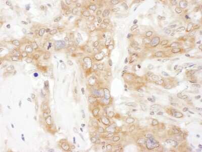 <b>Biological Strategies Validation. </b>Immunohistochemistry: VAP-A Antibody [NBP2-32249] - Sample: FFPE section of human breast carcinoma. Antibody: Affinity purified rabbit anti- VAP-33 used at a dilution of 1:1,000 (1ug/ml). Detection: DAB. Counterstain: IHC Hematoxylin (blue).