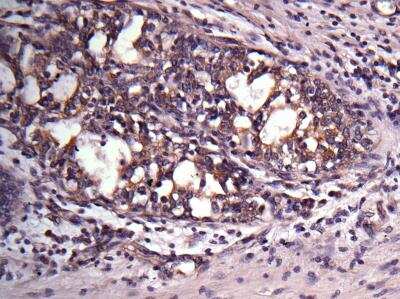 Immunohistochemistry-Paraffin: VAP-A Antibody [NBP1-31237] -  Human breast cancer, using VAPA antibody at 1:500 dilution. 