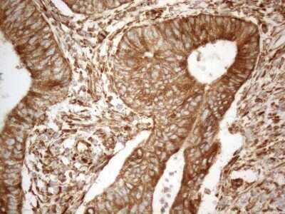 Immunohistochemistry: VAP-A Antibody (OTI10E10) - Azide and BSA Free [NBP2-74825] - Analysis of Adenocarcinoma of Human colon tissue. (Heat-induced epitope retrieval by 1mM EDTA in 10mM Tris buffer (pH8.5) at 120C for 3 min)