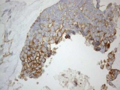 Immunohistochemistry: VAP-A Antibody (OTI10E10) - Azide and BSA Free [NBP2-74825] - Analysis of Adenocarcinoma of Human endometrium tissue. (Heat-induced epitope retrieval by 1mM EDTA in 10mM Tris buffer (pH8.5) at 120C for 3 min)