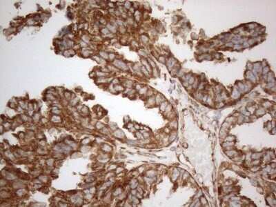 Immunohistochemistry: VAP-A Antibody (OTI10E10) - Azide and BSA Free [NBP2-74825] - Analysis of Adenocarcinoma of Human ovary tissue. (Heat-induced epitope retrieval by 1mM EDTA in 10mM Tris buffer (pH8.5) at 120C for 3 min)