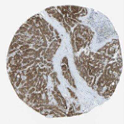 Immunohistochemistry: VAP-B Antibody [21200002] - Normal tissues generally showed strong cytoplasmic staining usually with membranous positivity. Malignant tissues displayed similar staining pattern as their normal counterparts.  Image and statement courtesy of the Human Protein Atlas (HPA).