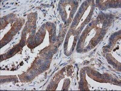 Immunohistochemistry: VASP Antibody (OTI4D6) - Azide and BSA Free [NBP2-74830] - Staining of paraffin-embedded Adenocarcinoma of Human colon tissue using anti-VASP mouse monoclonal antibody.