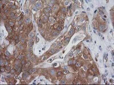 Immunohistochemistry: VASP Antibody (OTI4D6) - Azide and BSA Free [NBP2-74830] - Staining of paraffin-embedded Carcinoma of Human bladder tissue using anti-VASP mouse monoclonal antibody.