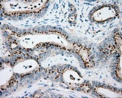 Immunohistochemistry: VAT1L Antibody (OTI1H3) - Azide and BSA Free [NBP2-74831] - Staining of paraffin-embedded Adenocarcinoma of colon tissue using anti-VAT1L mouse monoclonal antibody.