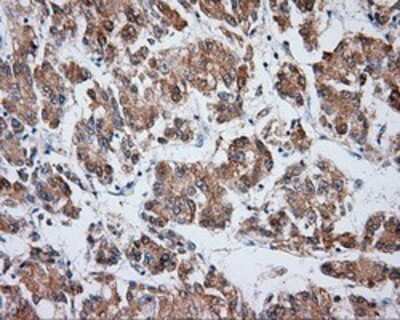 Immunohistochemistry: VAT1L Antibody (OTI1H3) - Azide and BSA Free [NBP2-74831] - Staining of paraffin-embedded Carcinoma of liver tissue using anti-VAT1L mouse monoclonal antibody.