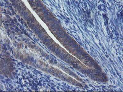 Immunohistochemistry-Paraffin: VBP1 Antibody (2A3) [NBP2-03754] - Staining of paraffin-embedded Adenocarcinoma of Human endometrium tissue using anti-VBP1 mouse monoclonal antibody.