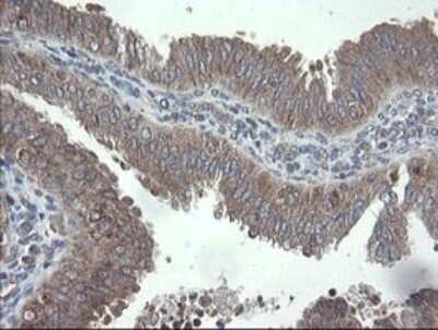 Immunohistochemistry: VBP1 Antibody (2E6) [NBP2-46329] - Analysis of Adenocarcinoma of Human endometrium tissue.