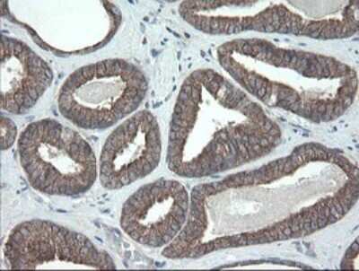 Immunohistochemistry: VBP1 Antibody (2E6) [NBP2-46329] - Analysis of Carcinoma of Human prostate tissue.