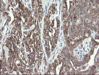 Immunohistochemistry: VBP1 Antibody (2E6) [NBP2-46329] - Analysis of Carcinoma of Human kidney tissue.