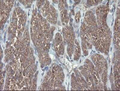 Immunohistochemistry: VBP1 Antibody (2E6) [NBP2-46329] - Analysis of Carcinoma of Human thyroid tissue.