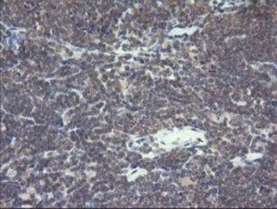 Immunohistochemistry: VBP1 Antibody (2E6) [NBP2-46329] - Analysis of Human lymphoma tissue.