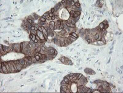 Immunohistochemistry: VBP1 Antibody (2E6) [NBP2-46329] - Analysis of Adenocarcinoma of Human colon tissue.