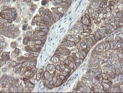 Immunohistochemistry: VBP1 Antibody (2E6) [NBP2-46329] - Analysis of Adenocarcinoma of Human ovary tissue.