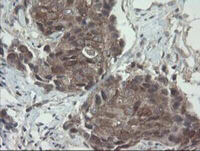 Immunohistochemistry: VBP1 Antibody (2E6) [NBP2-46329] - Analysis of Adenocarcinoma of Human breast tissue .