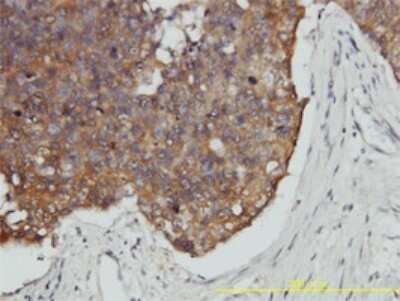 Immunohistochemistry-Paraffin: VBP1 Antibody (3D11) [H00007411-M01] - Analysis of monoclonal antibody to VBP1 on formalin-fixed paraffin-embedded human breast cancer tissue. Antibody concentration 5 ug/ml.