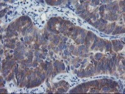 Immunohistochemistry: VBP1 Antibody (OTI2A3) - Azide and BSA Free [NBP2-74833] - Staining of paraffin-embedded Adenocarcinoma of Human ovary tissue using anti-VBP1 mouse monoclonal antibody.