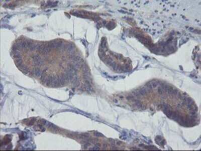 Immunohistochemistry: VBP1 Antibody (OTI2A3) - Azide and BSA Free [NBP2-74833] - Staining of paraffin-embedded Carcinoma of Human pancreas tissue using anti-VBP1 mouse monoclonal antibody.