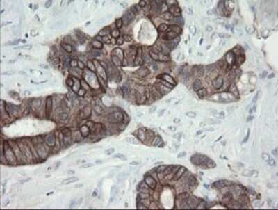 Immunohistochemistry: VBP1 Antibody (OTI2E6) - Azide and BSA Free [NBP2-74836] - Analysis of Adenocarcinoma of Human colon tissue.