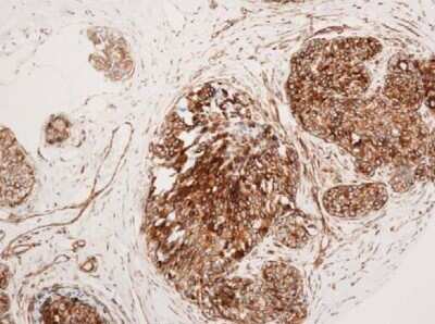 Immunohistochemistry: VCAM-1/CD106 Antibody (6G9) - Azide and BSA Free [NBP2-81005] - Breast carcinoma, cytoplasmic staining. Image from verified customer review. Image from the standard format of this antibody.