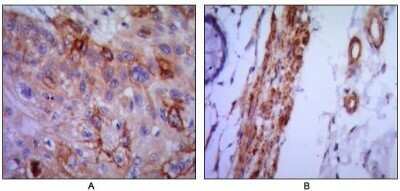 Immunohistochemistry: VCAM-1/CD106 Antibody (6G9) - Azide and BSA Free [NBP2-81005] - (A) human lung cancer and (B) colon cancer using VCAM1 mouse mAb with DAB staining. Image from the standard format of this antibody.